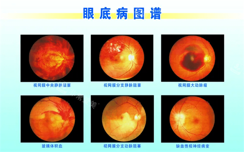 眼底病图谱示意图