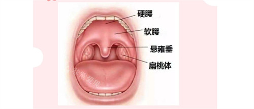 唇腭裂示意图