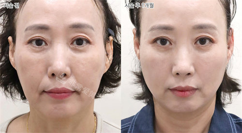 韓國(guó)selfi整形外科埋線提升手術(shù)正面前后對(duì)比圖 