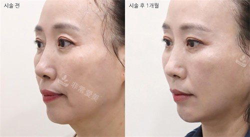 韓國(guó)selfi整形外科埋線提升手術(shù)側(cè)面前后對(duì)比圖 