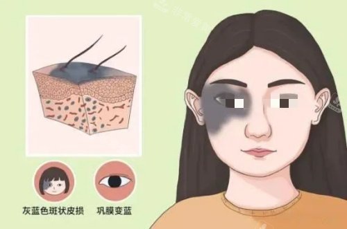 真皮斑形态示意图