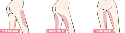 腿部吸脂部位展示动画图 腿部吸脂部位展示动画图