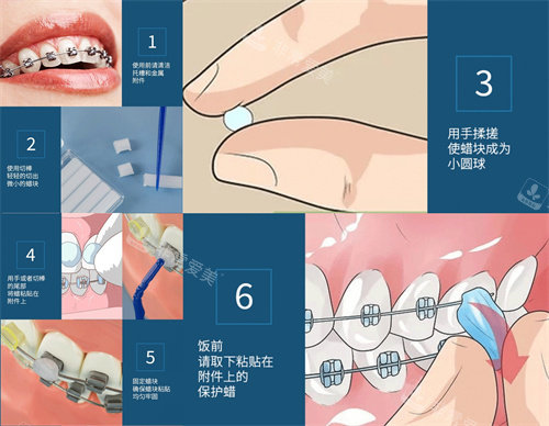 正畸保护蜡使用步骤演示漫画图
