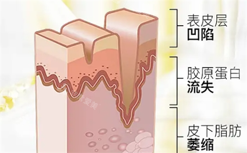 皮肤皱纹皮下组织剖面图
