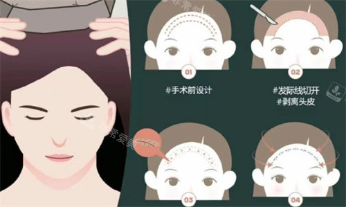 額頭縮小手術(shù)過程 額頭縮小手術(shù)過程