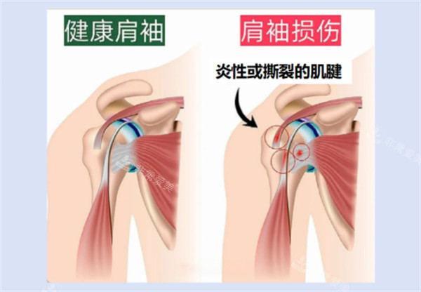 肩周損傷圖示 肩周損傷圖示
