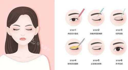 拉双眼皮手术示意图 拉双眼皮手术示意图
