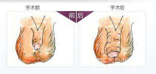 在韩国做了阴茎延长加粗手术，术后结果很满意手术经历分享给大家！