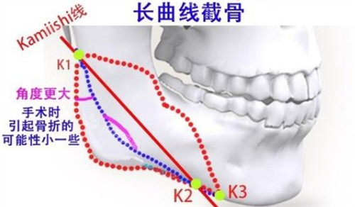 下頜角長曲線截骨的截骨位置 下頜角長曲線截骨的截骨位置