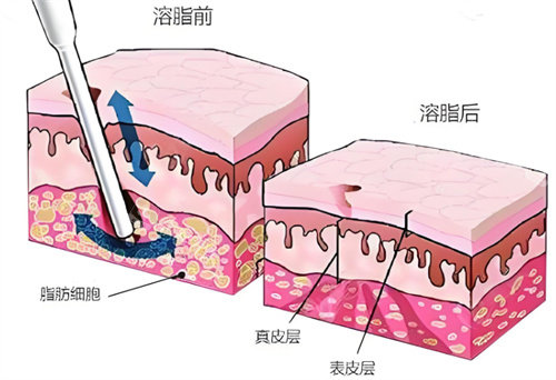 射頻溶脂術(shù)皮膚層 射頻溶脂術(shù)皮膚層