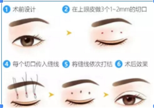 2025年华美整形医院价格表查询:双眼皮/隆鼻/隆胸、吸脂/填充、玻尿酸、热玛吉...