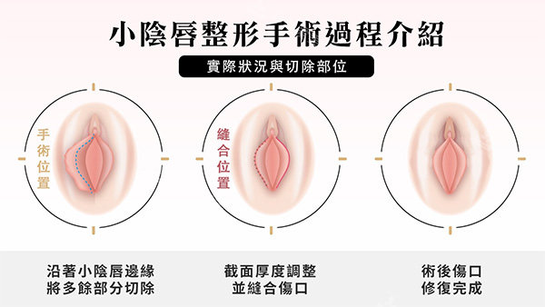 阴唇一边长一边短改善照片 阴唇一边长一边短改善照片