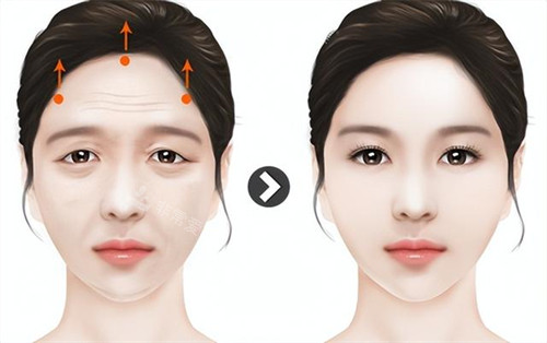 拉皮提眉手术演示动画图 拉皮提眉手术演示动画图