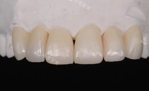 爱迪特全瓷牙示意图