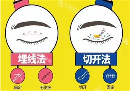 雙眼皮埋線和切開對比圖 雙眼皮埋線和切開對比圖