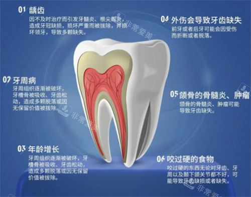 牙齿缺失原因