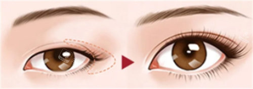 開外眼角術(shù)對(duì)比圖 開外眼角術(shù)對(duì)比圖