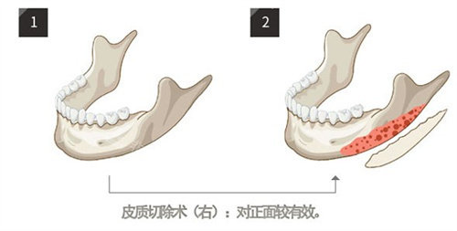 下頜角削骨 下頜角削骨