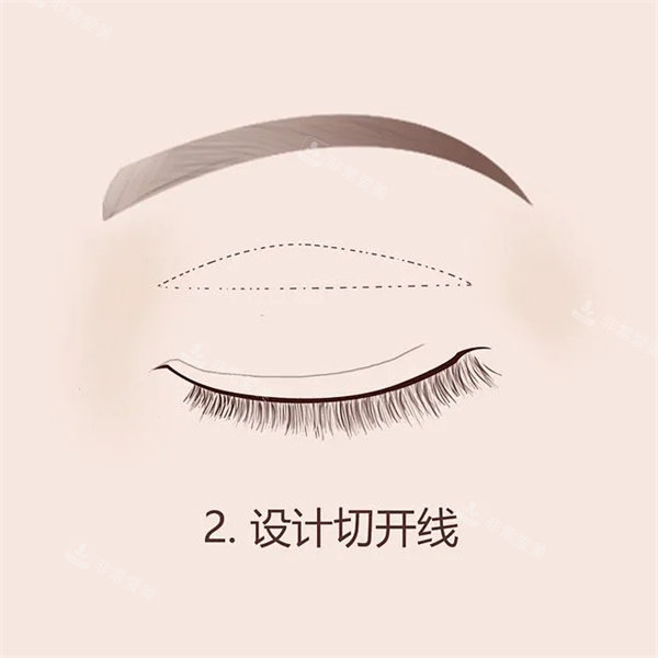 双眼皮手术 双眼皮手术