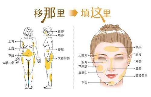 自体脂肪面部填充步骤图