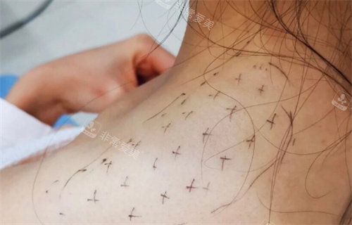 瘦肩注射点位设计图 瘦肩注射点位设计图