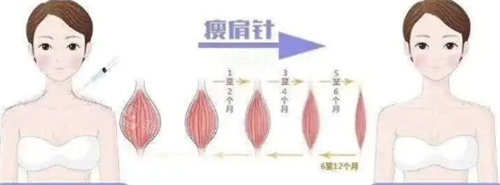 瘦肩针注射过程变化图 瘦肩针注射过程变化图