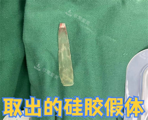 取出的硅胶假体照片