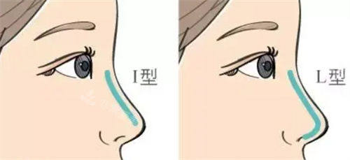 隆鼻不同形态假体呈现图