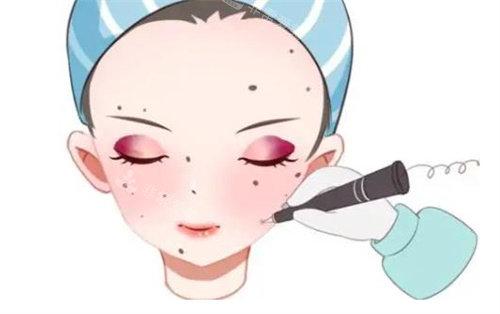 激光去痣卡通