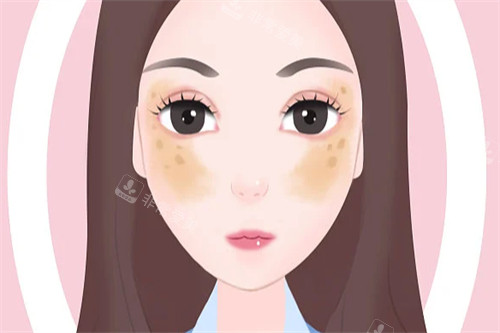 黄褐斑图片一览