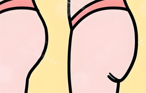 提臀手術(shù)對比 提臀手術(shù)對比