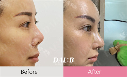 Dal b整形外科鼻整形前后對(duì)比 Dal b整形外科鼻整形前后對(duì)比