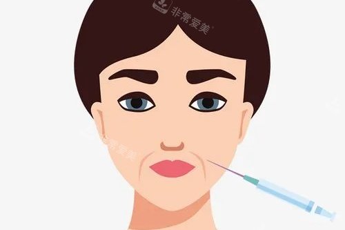 法令纹注射卡通图展示