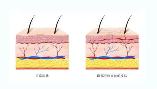 红血丝的皮肤和正常皮肤的对比