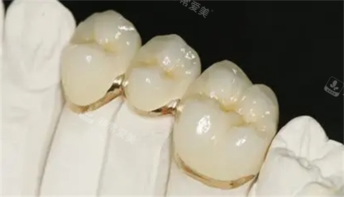 烤瓷牙安装成效展示图