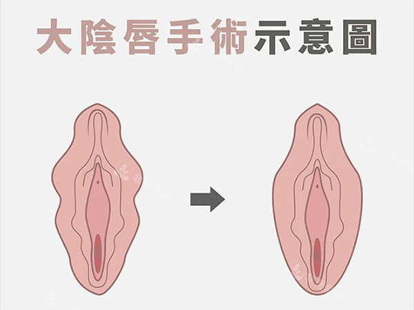 大陰唇整形前后照片 大陰唇整形前后照片