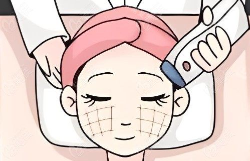 热玛吉操作过程