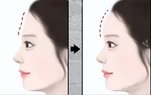 假体填充额头手术前后对比动画图 假体填充额头手术前后对比动画图