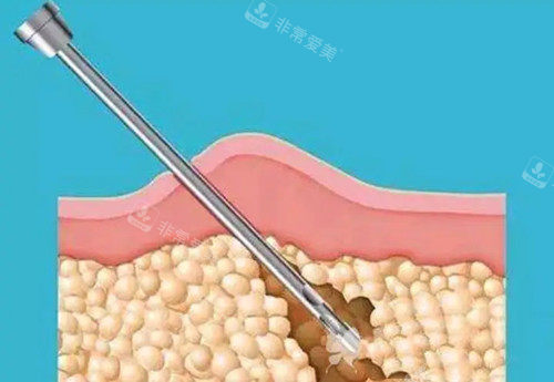 成都大腿吸脂哪家医院...