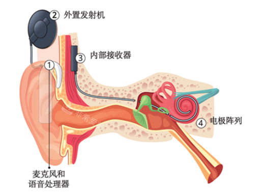 人工耳蜗