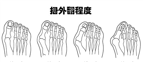 大脚骨外翻程度