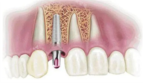 种植牙动画模拟图