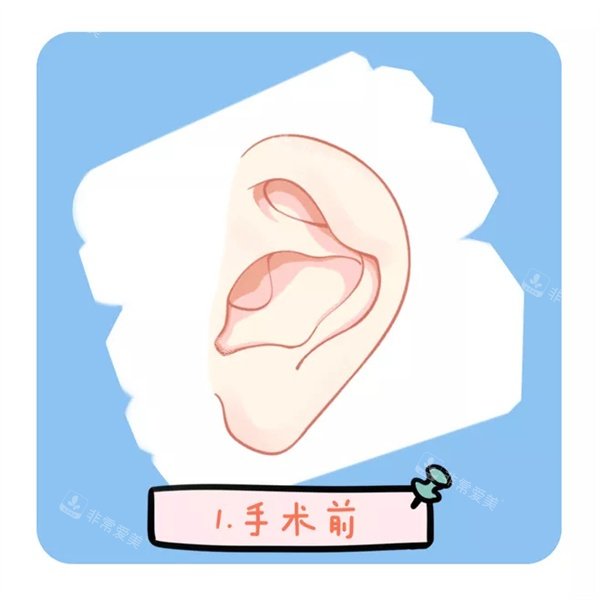 耳畸形矫正 耳畸形矫正
