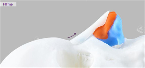 FITme3D鼻假体材料展示图