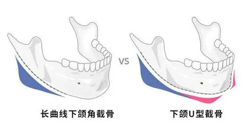 下頜角截骨位置示意圖