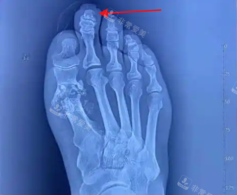 需要二趾缩短手术的情况