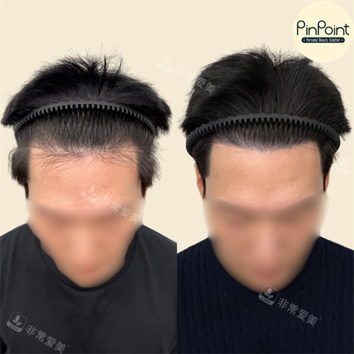 韓國Pinpoint Lab半永久店紋發(fā)際線對比圖 韓國Pinpoint Lab半永久店紋發(fā)際線對比圖