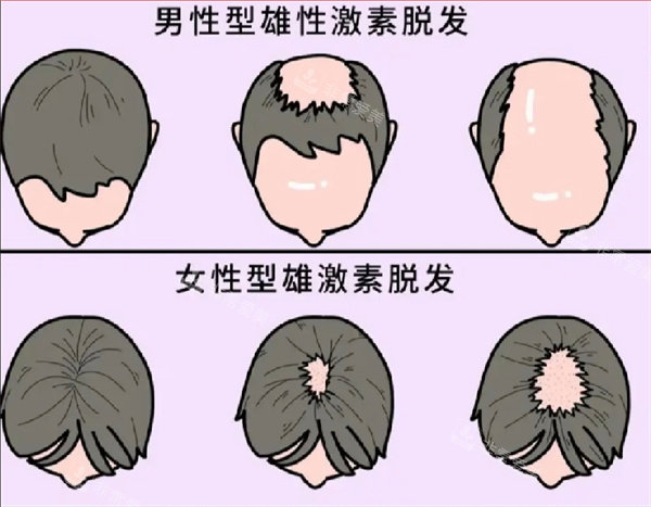 脱发图片 脱发图片