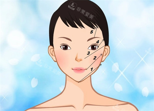 线提升 线提升