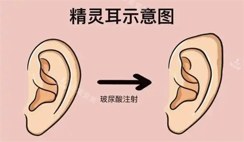 精靈耳注射